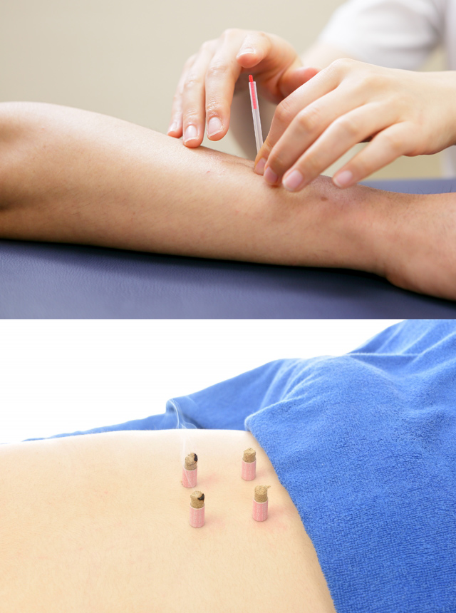 鍼灸のイメージ